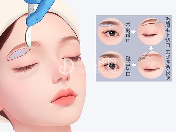 眼部衰老的原因及抗衰治疗分析