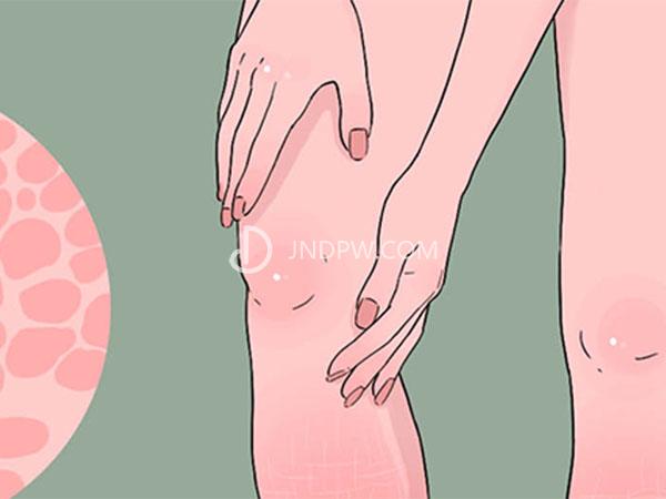 鱼鳞病皮肤怎么改善？鱼鳞病患者的日常禁忌